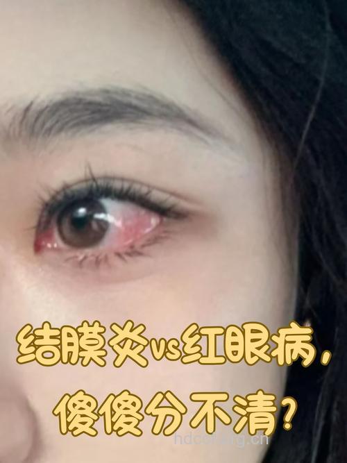 红眼病有真假 如何辨别真假红眼病