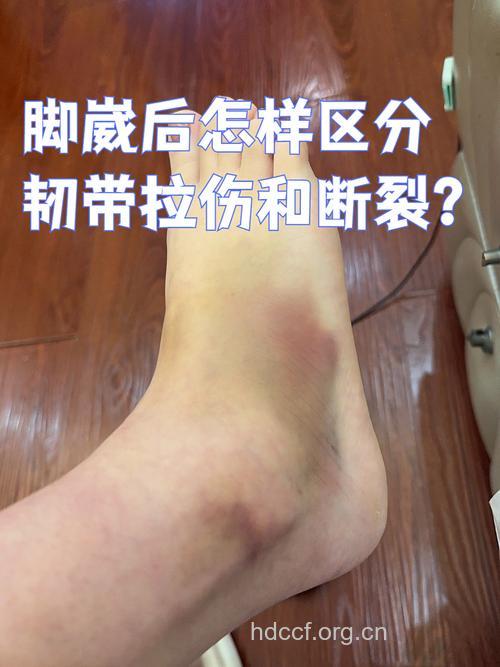 踝关节扭伤的表现症状有哪些