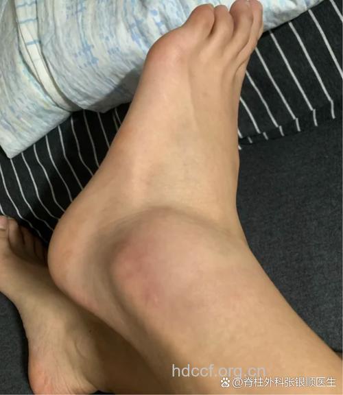 踝关节扭伤的两大症状