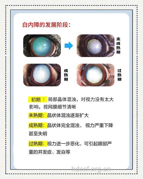 白内障常见的六大类型