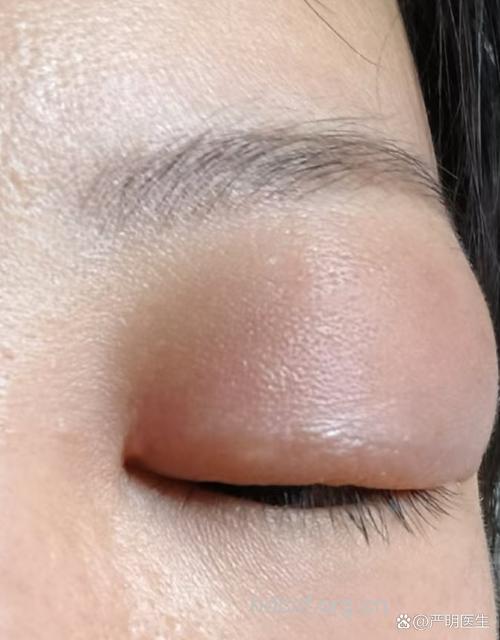 一觉醒来眼睛肿成包子 当心这是眼睛过敏