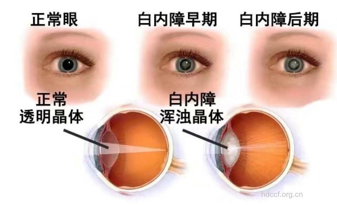先天性白内障的特点是什么