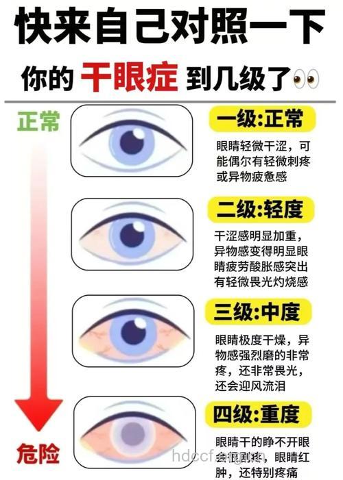 干眼症常见4种早期症状