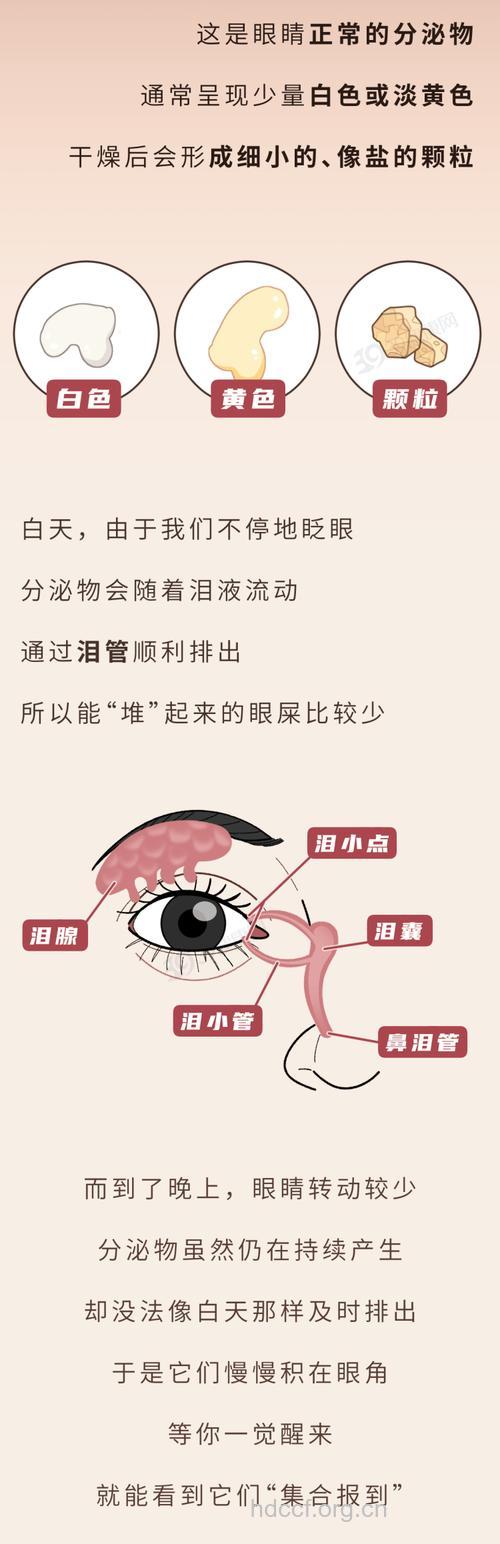 早起眼屎多正常吗 注意4种原因