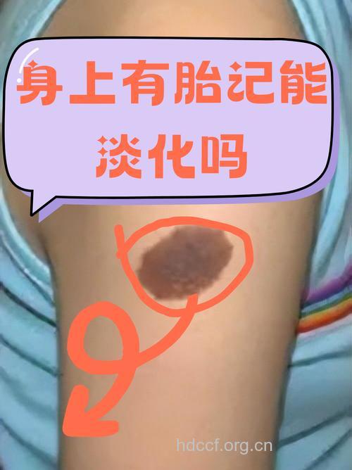 胎记带来烦恼