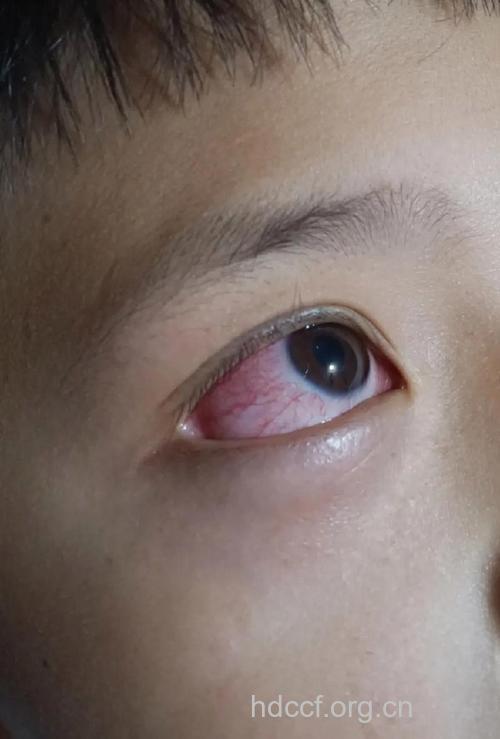 红眼病的症状表现有哪些
