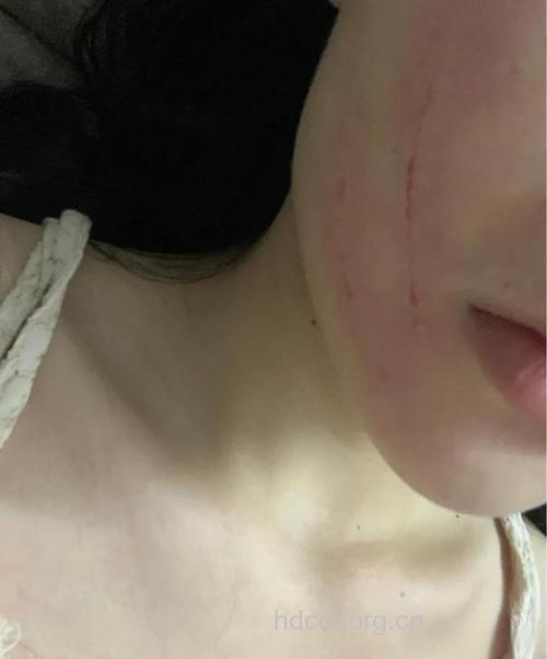 丈夫耳光使妻子致聋