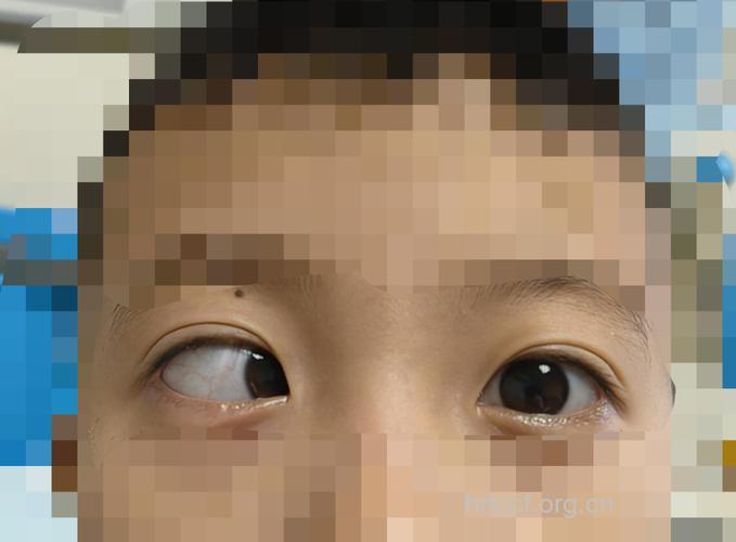 儿童斜视的主要症状有哪些