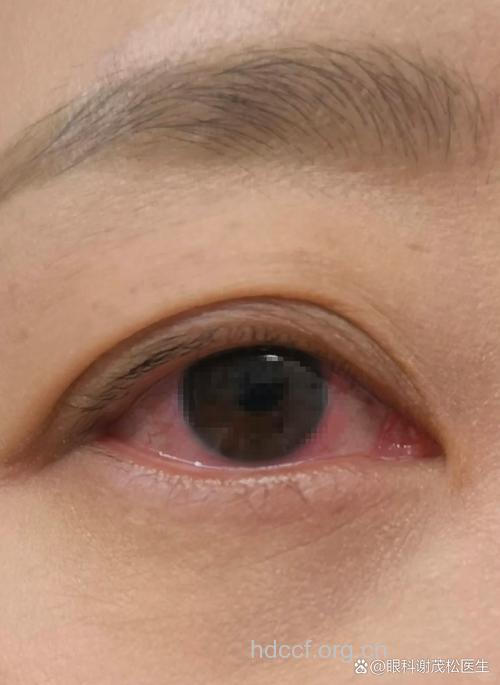 红眼病的几个早期症状