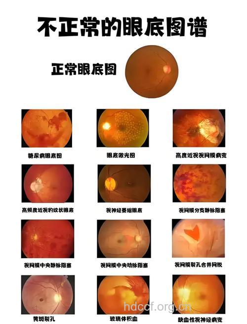 警惕！眼球最底部的一些病
