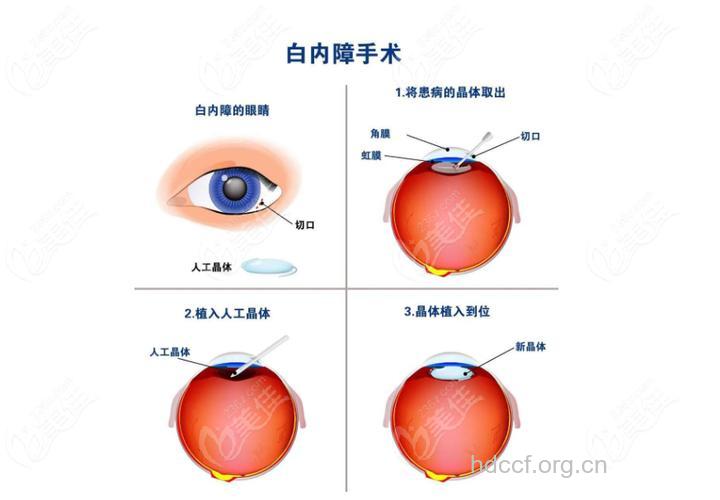白内障手术的过程介绍