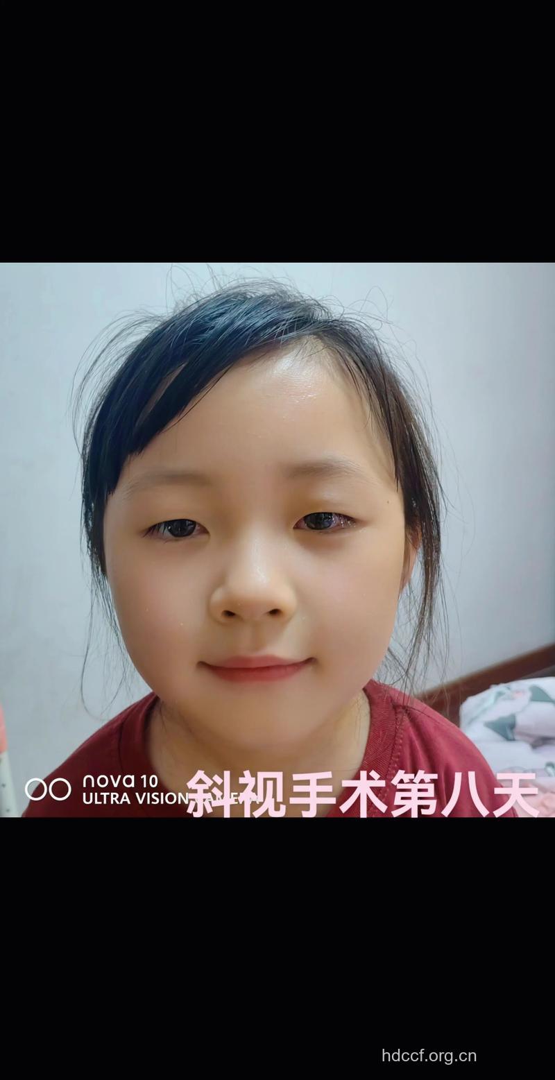 斜视手术眼睛会留疤吗