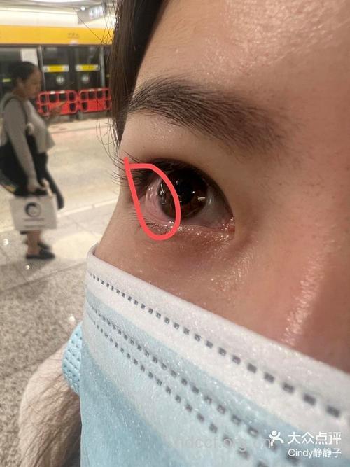 地摊假睫毛引发红眼病
