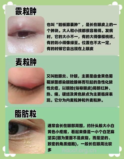 麦粒肿(针眼)简介 麦粒肿症状及治疗