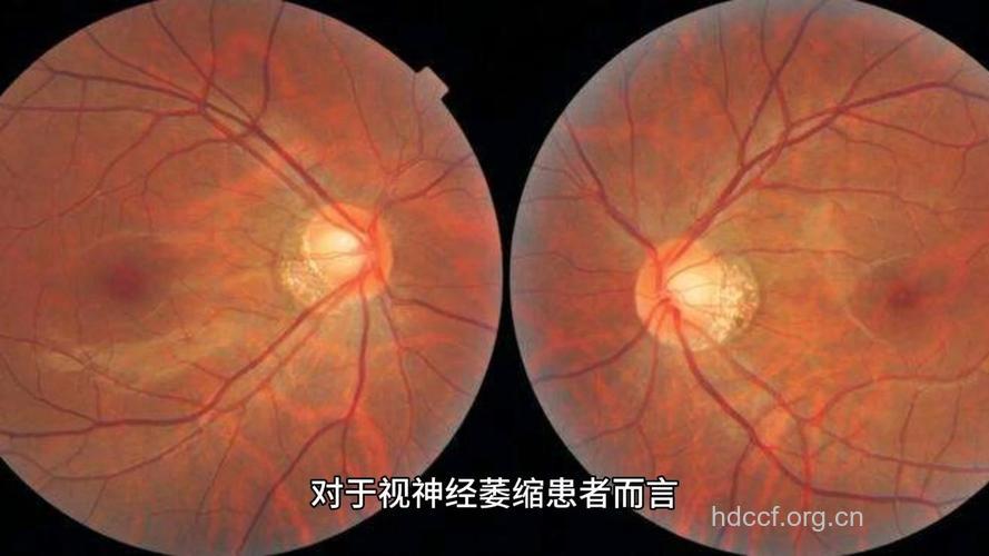什么是视神经萎缩