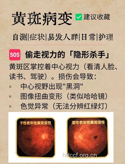 老年性黄斑变性的治疗方法