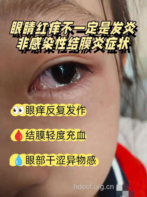 出门在外少揉眼 眼红不一定是红眼病