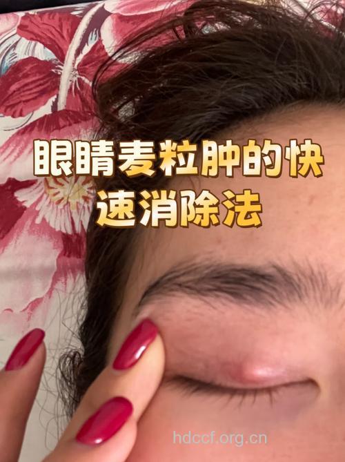 蒲公英治疗麦粒肿的方法