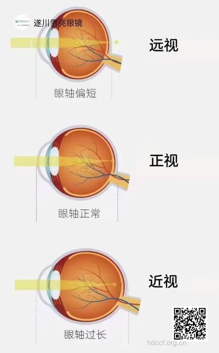 近视、散光都是屈光不正