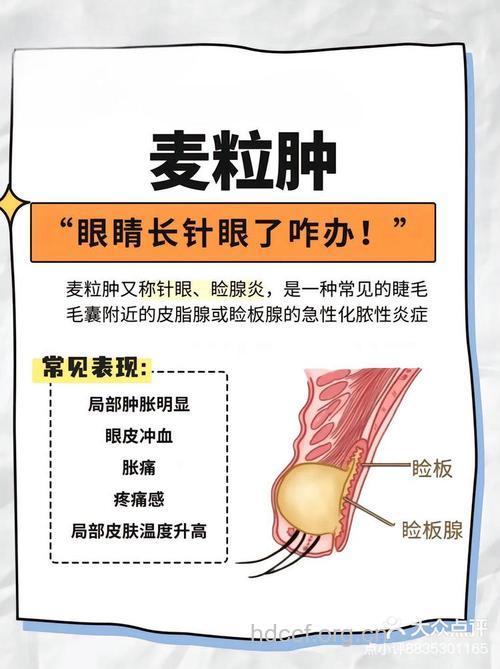 麦粒肿千万别用手挤