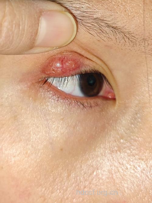 眼睛麦粒肿的症状有哪些
