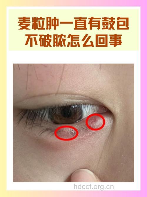 什么是麦粒肿