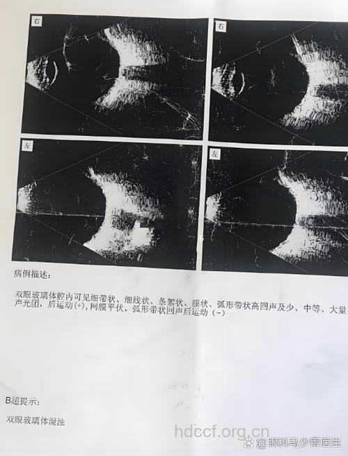 眼睛突然看不见 一片黑色是怎么回事