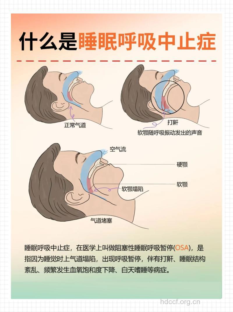 打鼾白天困倦 警惕睡眠呼吸暂停综合征