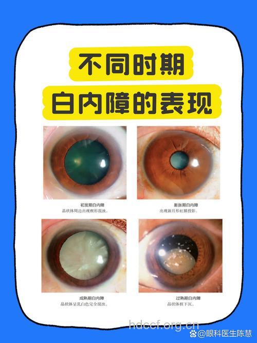 白内障手术后视力恢复差的原因