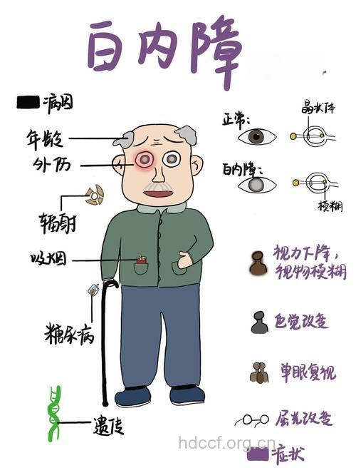 白内障的分类与病因