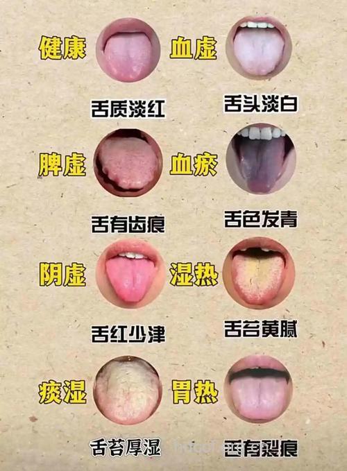 齿痕舌如何调理 健脾利湿是关键