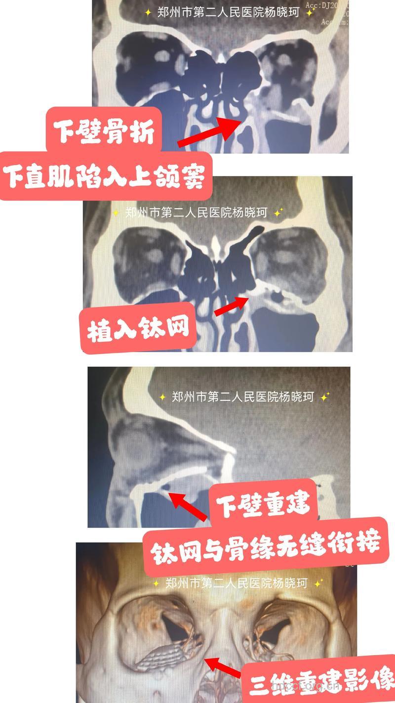 眼眶击出性骨折的治疗