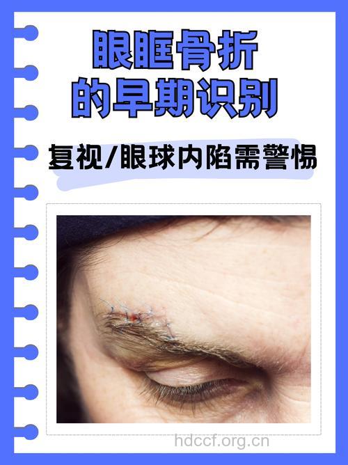 眼眶击出性骨折临床表现