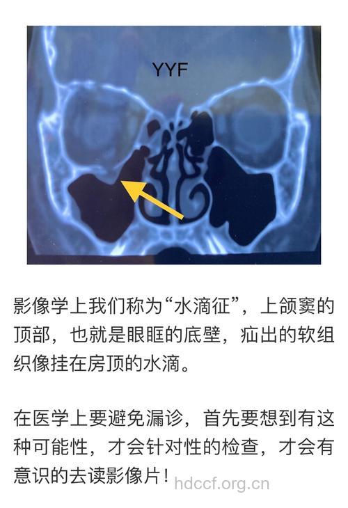 眼眶击出性骨折病因病理