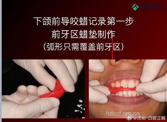生物材料在颌面部外伤治疗中的应用