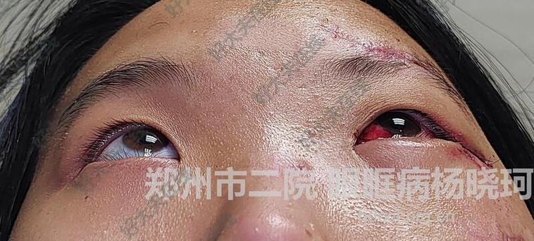 移植物眶内植入治疗眼眶爆裂性骨折