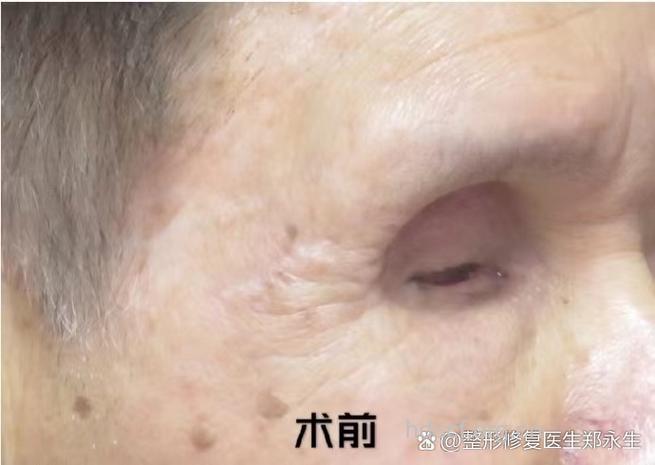 眼外伤后眶体萎缩致眼球内陷2例