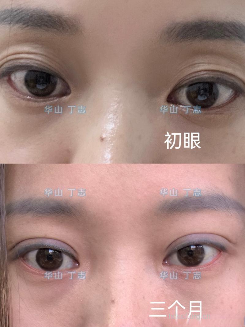 眼部整形之眼睑内陷整形术