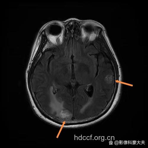 机械性眼球损伤的CT表现