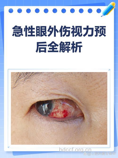 我国一项眼烧伤研究引起国际关注