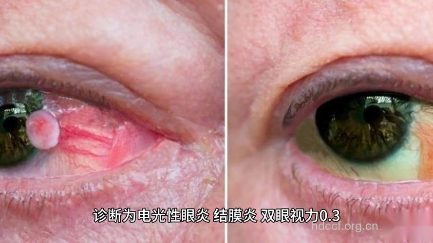 紫外线伤眼