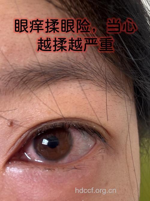 眯眼揉搓导致眼损伤