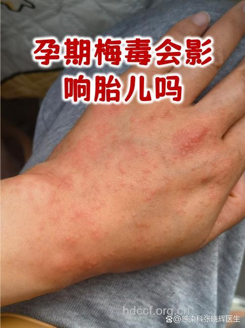 梅毒妇女怀孕有什么后果