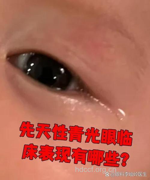 宝宝青光眼有哪些症状