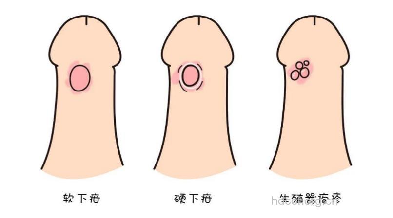 性行为感染性病者最小仅16岁