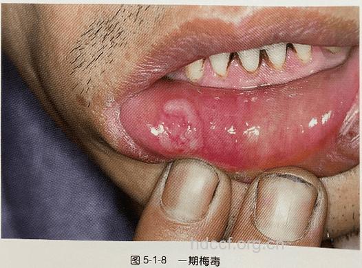 不良性行为惹来梅毒缠身