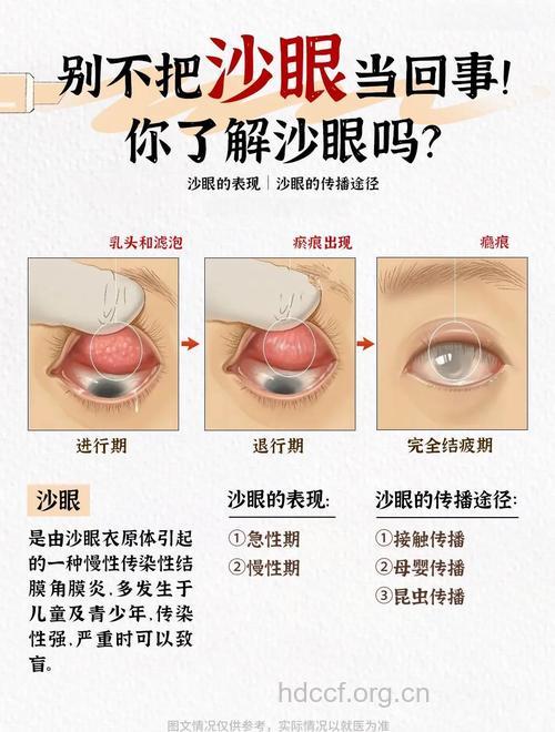 沙眼会对视力有哪些危害