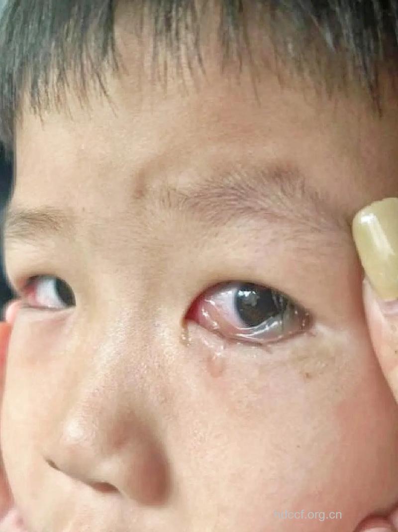 小孩经常揉眼睛可能引起沙眼