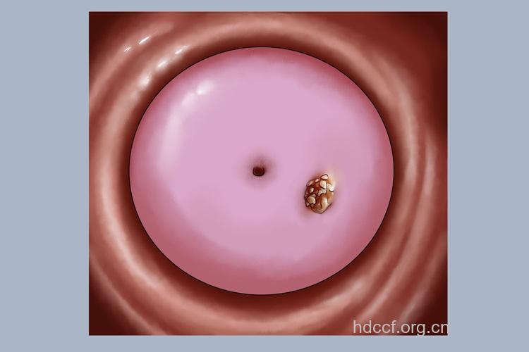 怀孕切得了尖锐湿疣