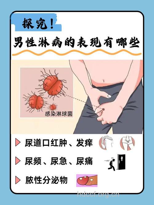 男性得淋病的症状有哪些？